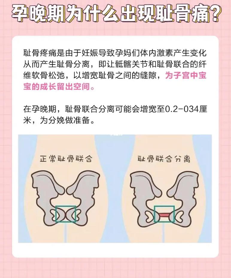 孕期耻骨痛怎么缓解,孕期耻骨痛怎么办缓解