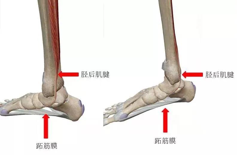 扁平足发病机制,扁平足诊断标准示意图