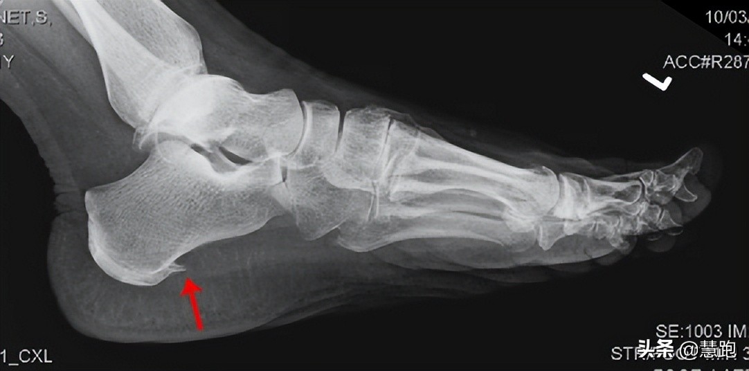 足底筋膜炎久治不愈怎么办,为什么足筋膜炎久治不愈