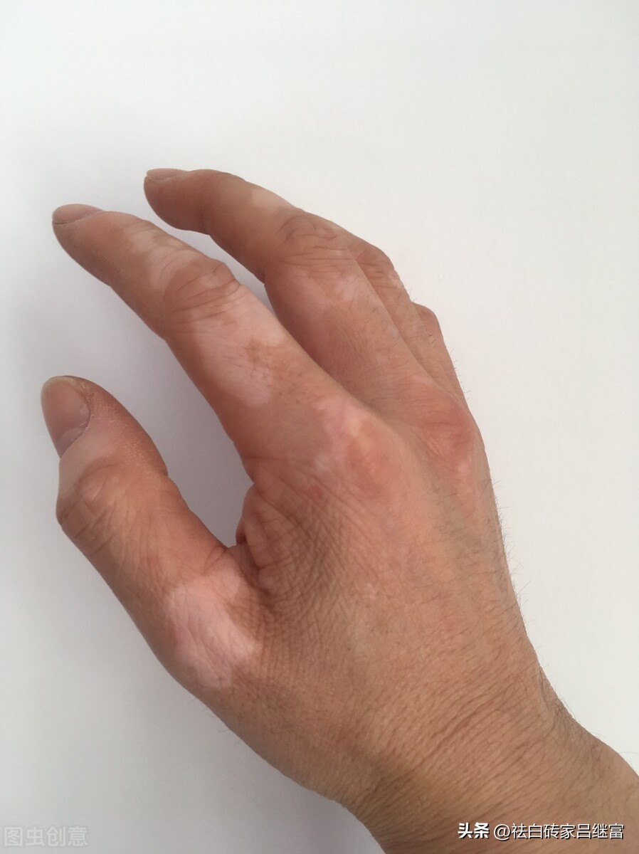 虫斑与花斑癣最主要区别,白癜风和汗斑最快鉴别方法