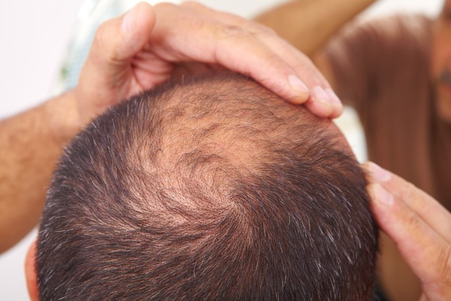 补气养血治疗脱发头发稀少,肾精亏虚导致的白发脱发怎么治