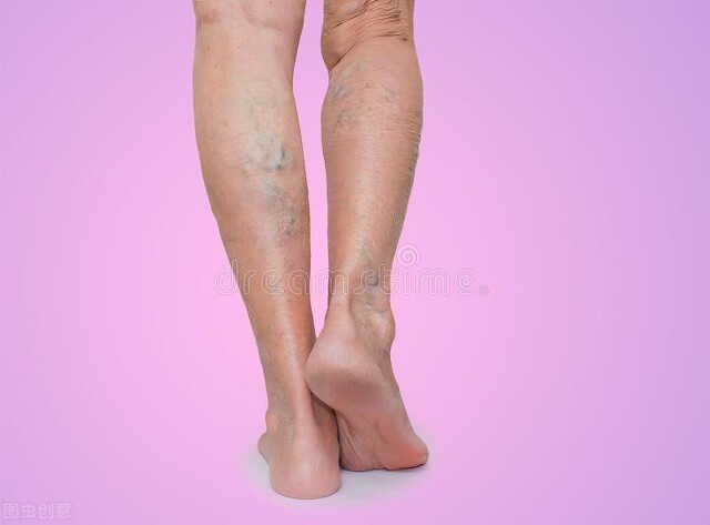 静脉曲张一级保守治疗动作,静脉曲张治疗的过程动画图