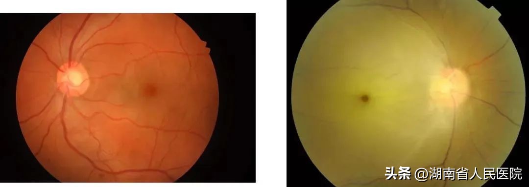 眼睛下面跳动是中风的前兆吗,眼睛中风后如何快速恢复视力