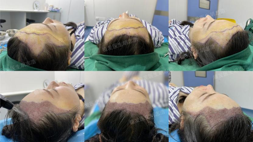 植发后后枕部的头发多久能恢复,植发3个月恢复图片