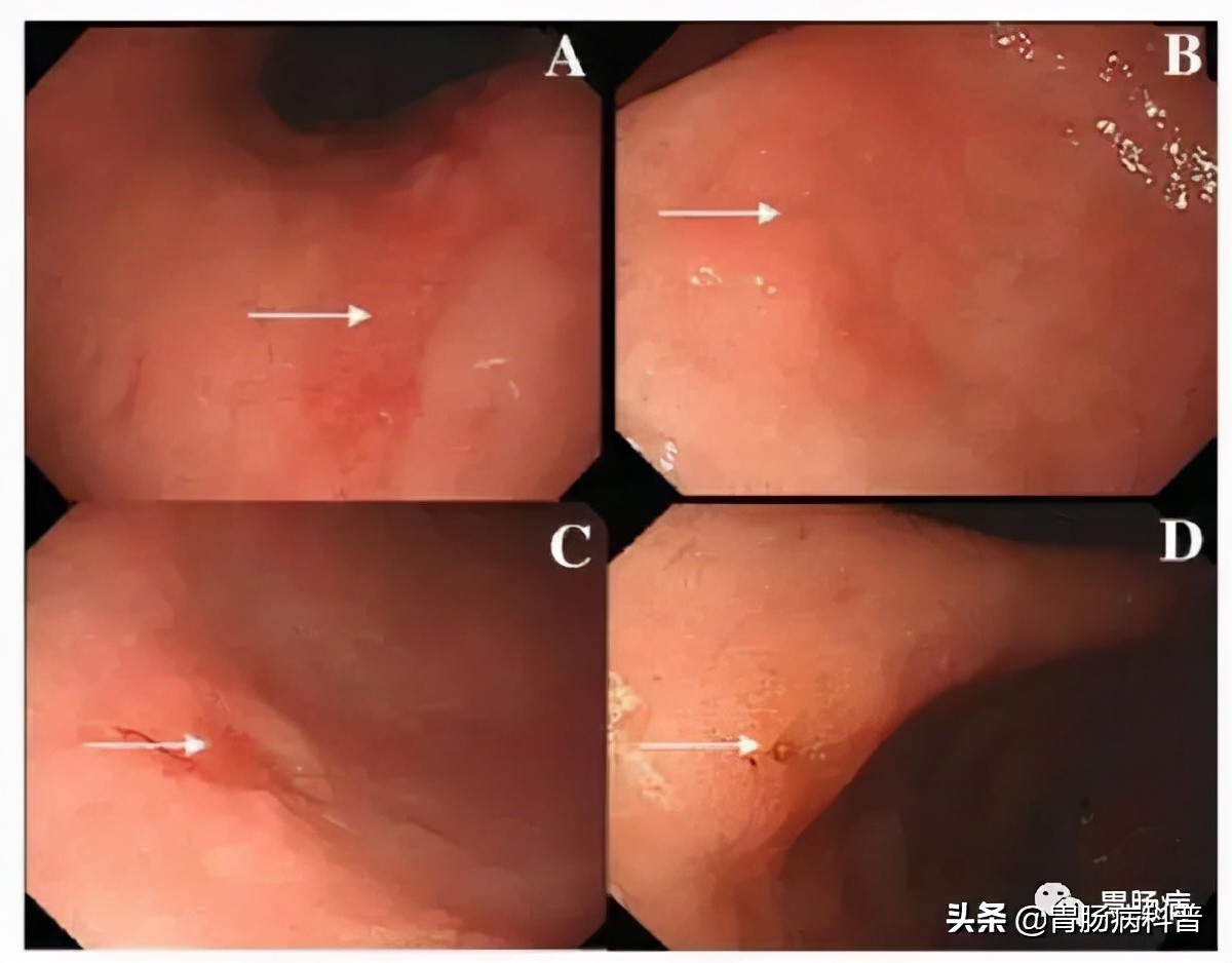 萎缩性胃炎伴肠化增生还能活多久,萎缩性胃炎肠化一定会发展增生吗