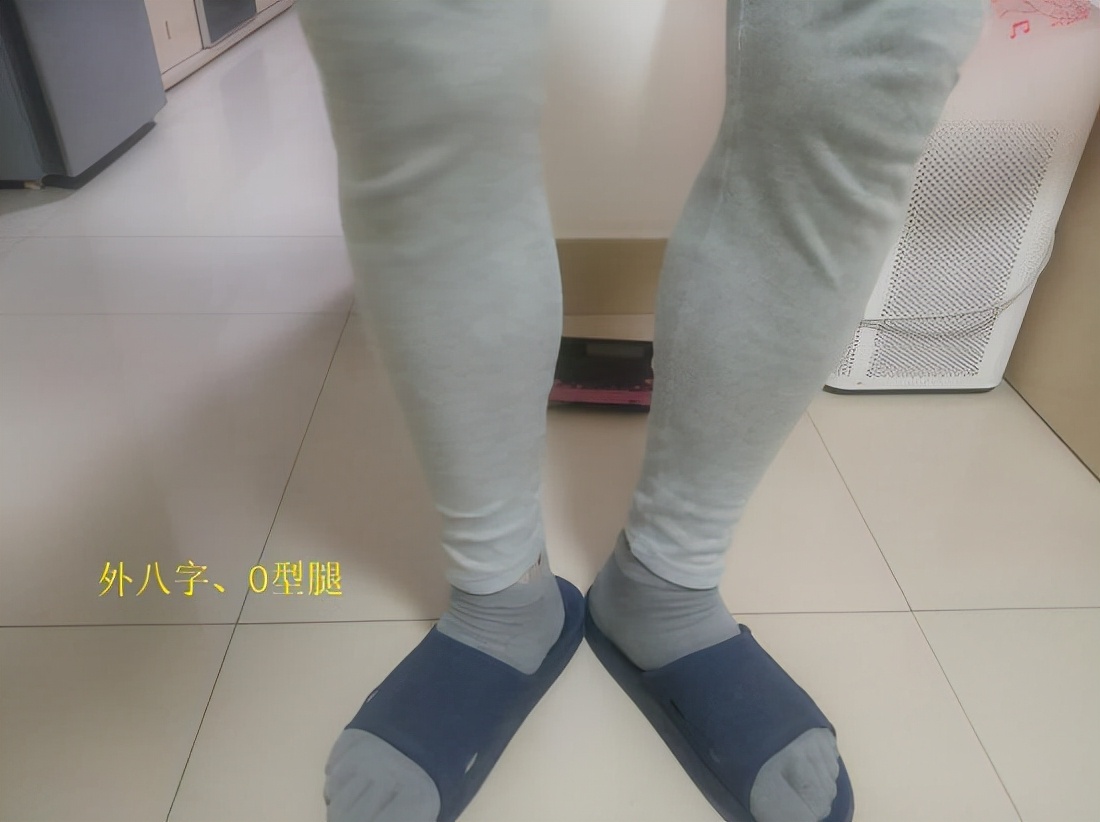 为什么会有o型腿,o型腿最有效矫正