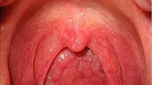 慢性咽炎有哪些症状与治疗方法,慢性咽炎怎么预防感冒