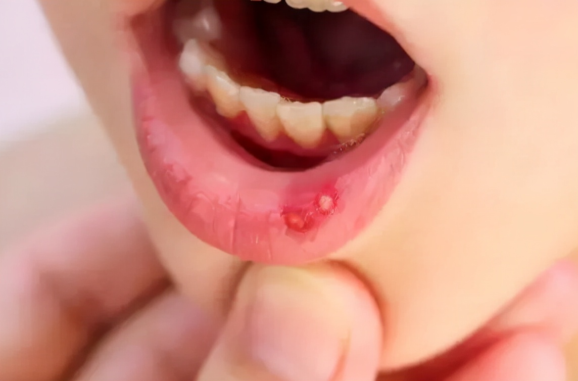 饮食不当引起胃不舒服怎么办,肺胃热导致的阴虚火旺怎么调