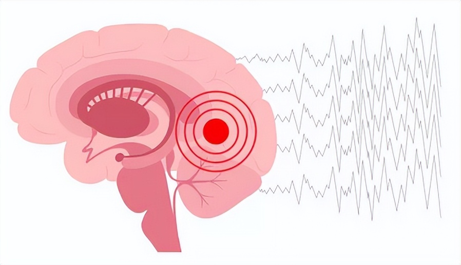 大脑异常放电会全身震颤吗,大脑异常放电一定会引起抽搐吗