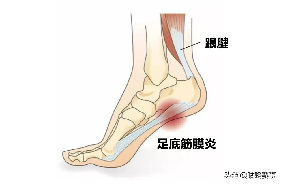 马拉松跑者足底筋膜炎,足底筋膜炎跑步治好