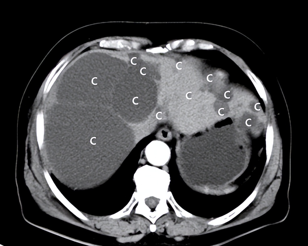 专家讲解多发肝囊肿治疗视频,多发性肝囊肿适合什么手术