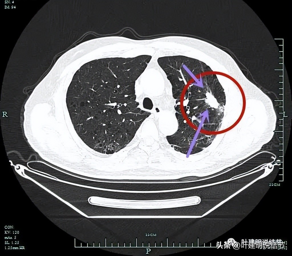 pet判断淋巴结转移,petct判断癌有没有转移准确吗