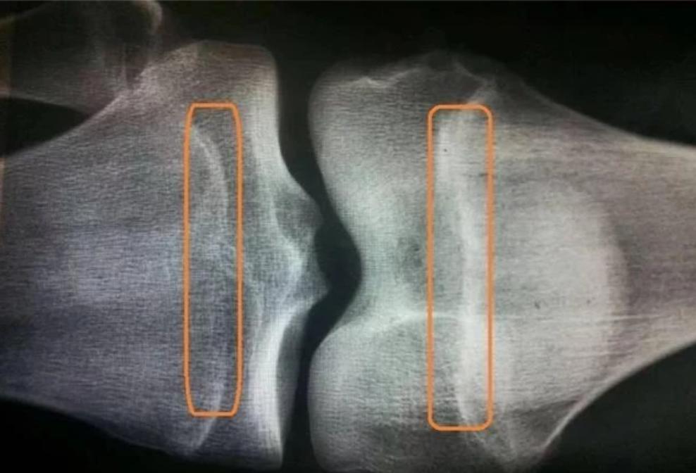 延缓骨龄增长运动最佳方法,延缓骨龄五大步骤