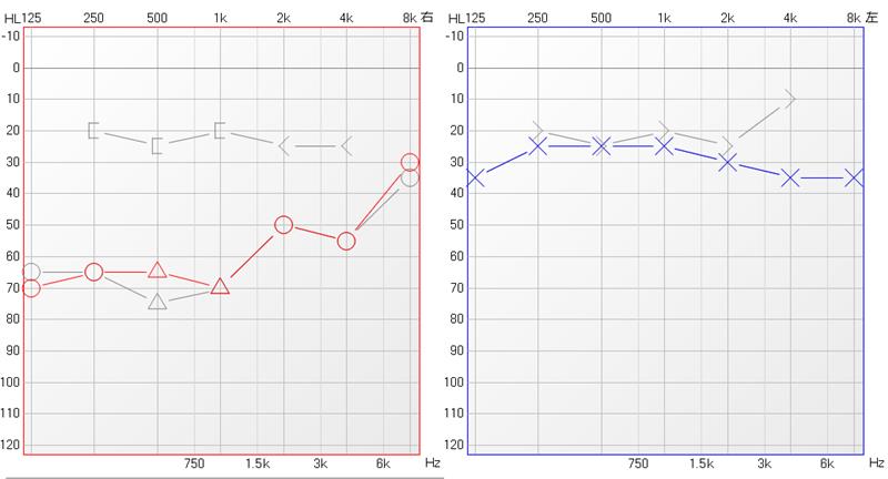 中耳炎耳内镜微创手术,慢性中耳炎流脓能做微创吗
