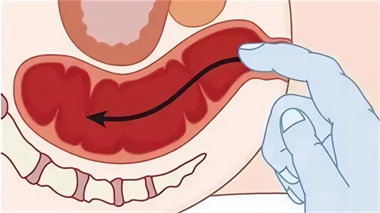 一直感觉大便拉不干净是怎么回事,大便感觉老是拉不干净是什么原因