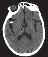 脑水肿的影像,脑水肿形成机制生理学