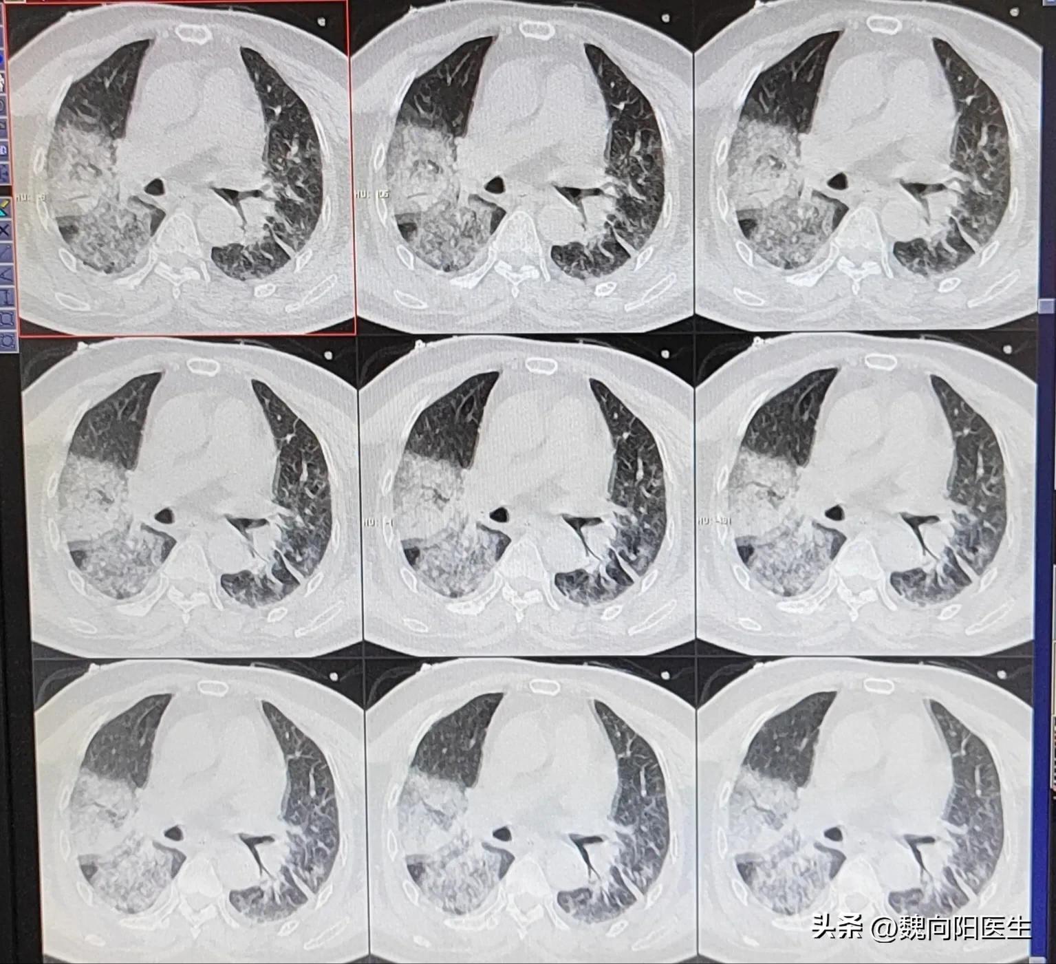 我的父亲大面积脑梗,我父亲脑梗3年后歪着坐在轮椅上