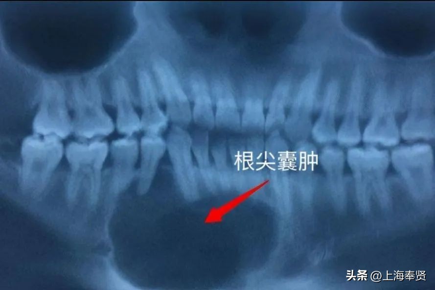 抽了牙神经以后牙就死了,抽了牙神经后牙齿断裂