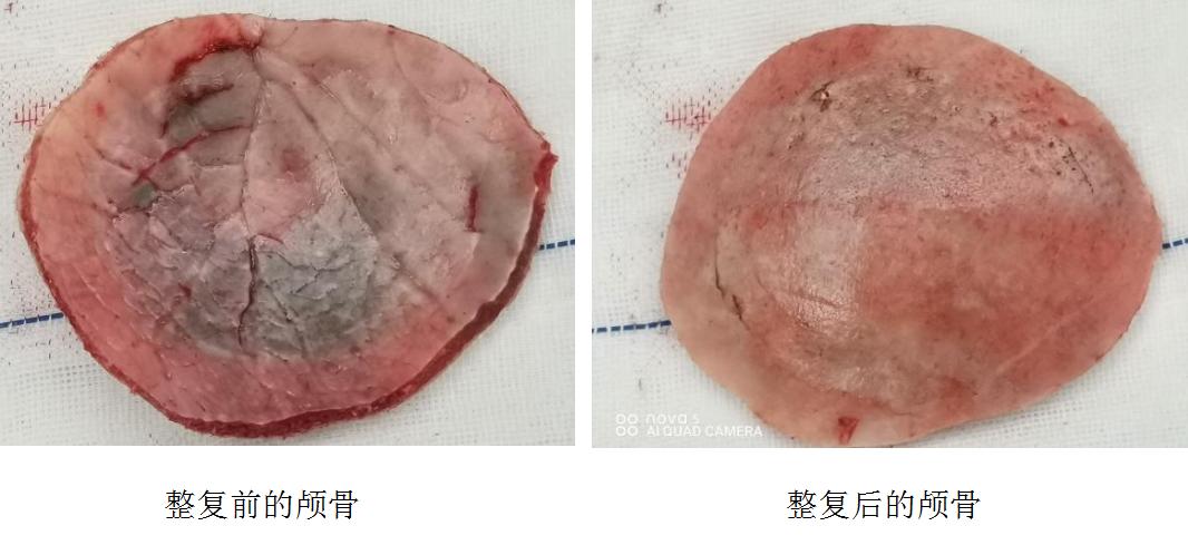 飞来横祸轮胎砸中脑袋,一男孩被铅球砸严重骨折
