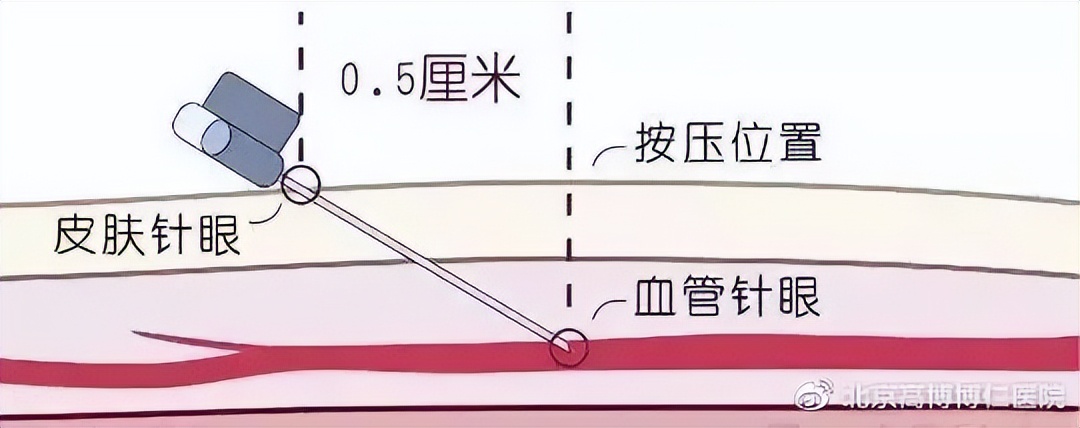 静脉采血处为什么会淤青很久,采血后出现淤青几小时后可以热敷