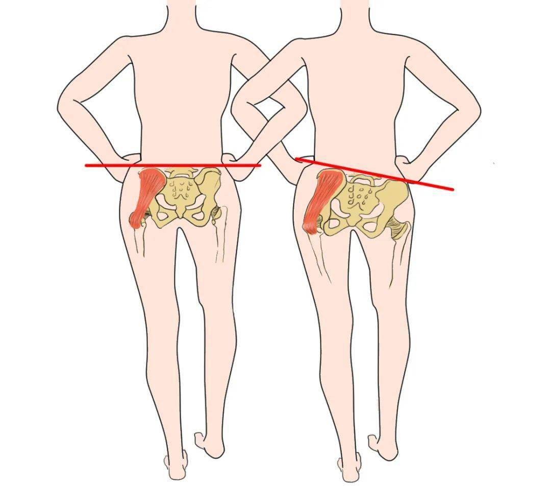 走路像鸭子臀中肌问题,走路左右摇摆像鸭子一样