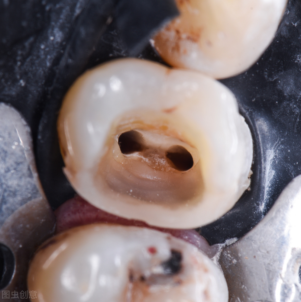 智齿拔掉怎么处理坏牙,拔烂牙和智齿有区别吗