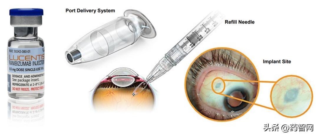 阿柏西普眼科神药,阿柏西普最新政策