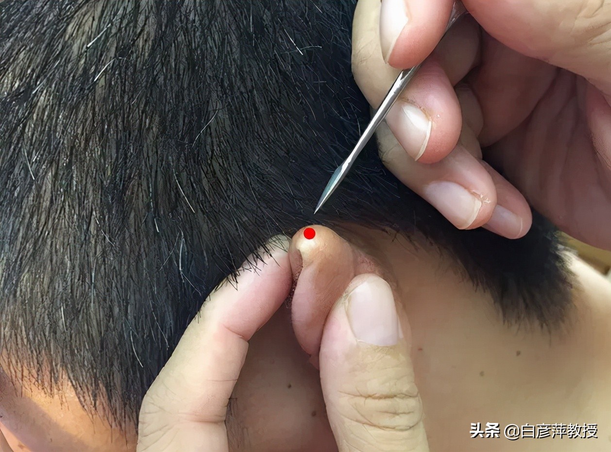 割耳放血可以治牛皮癣吗,民间老中医放血疗法治银屑病