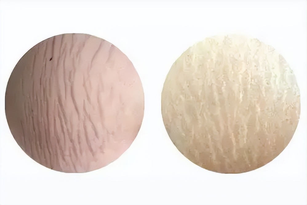 有祛除肥胖纹的真实案例吗,隐形肥胖怎么消除