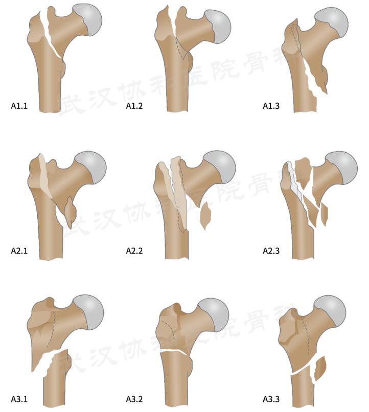 双导牵引矫正器,反向牵引复位固定器