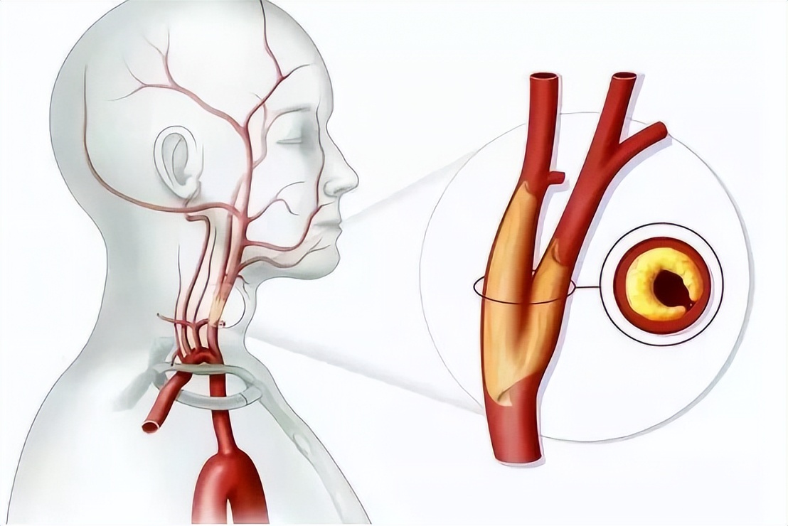 脑梗颈动脉斑块90%能治愈吗,有颈动脉斑块需要服他汀药吗