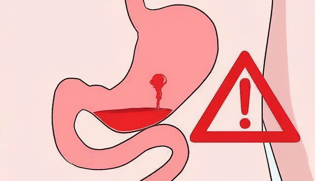 得了胃出血后喝酒能得胃癌吗,喝酒出血了是胃癌吗