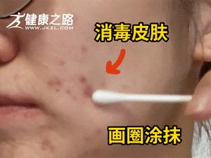 教你三天淡化痘印七天彻底祛除,怎样可以快速祛痘不留疤