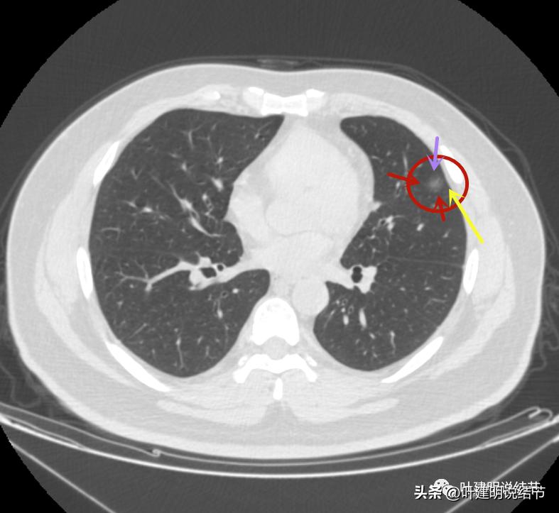 如何判断肺磨玻璃结节是高危结节,肺上有混合磨玻璃结节要注意什么
