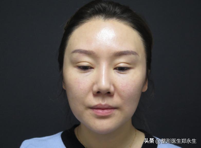 双眼皮修复恢复过程经历真实,修复双眼皮的亲身经历