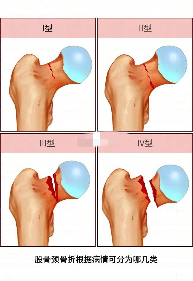 股骨颈骨折康复治疗,股骨颈骨折内固定康复