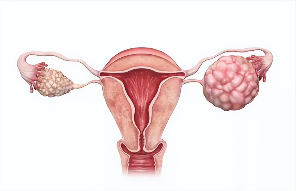 怀孕初期卵巢肿瘤,有什么民间草药可以治卵巢癌