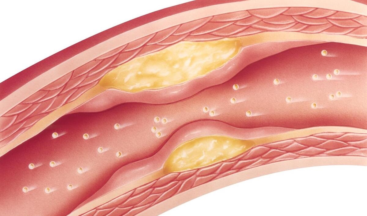 动脉斑块引起供血不足吃什么药,超声检查动脉斑块都有哪些部位