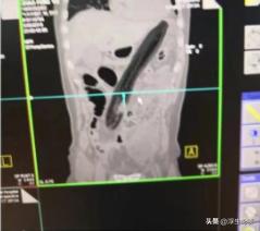 广东60岁男子直肠取出异物,小伙的直肠有25公分的异物