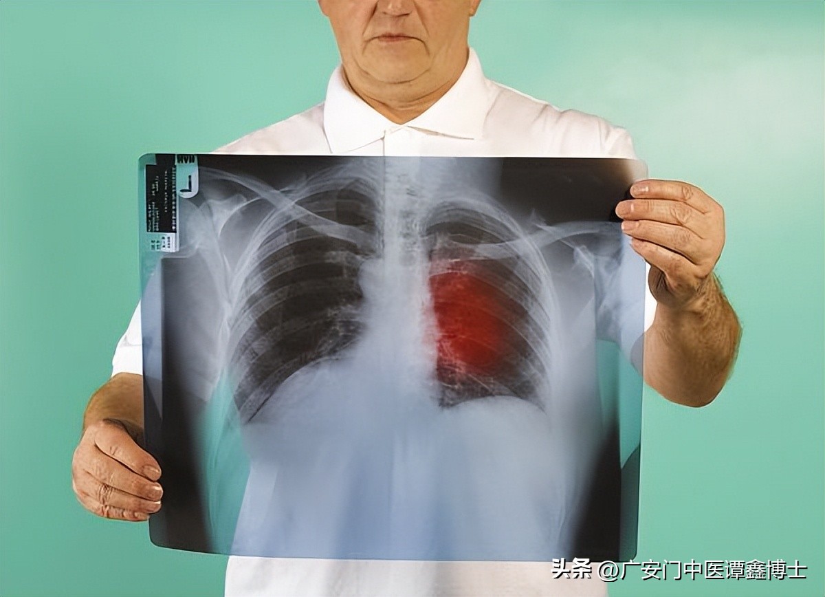 肺癌晚期有没有治疗必要？应该如何饮食？