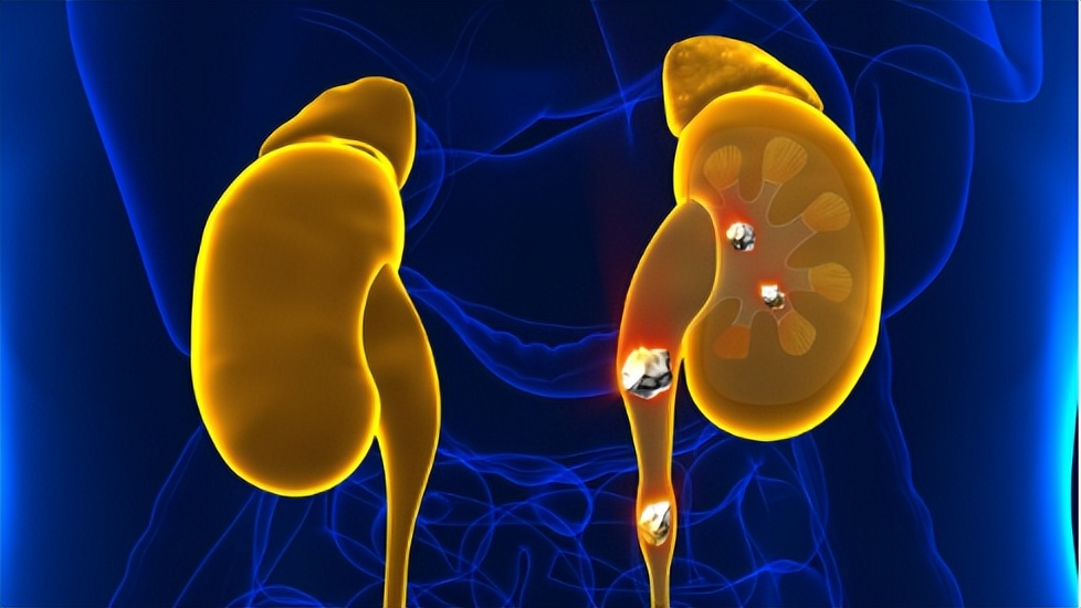 肾结石能吃蛋一类的食物吗,肾结石治疗期间可以吃鸡蛋吗