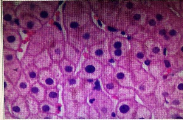黄疸遗传代谢性疾病,遗传代谢性黄疸怎么治疗