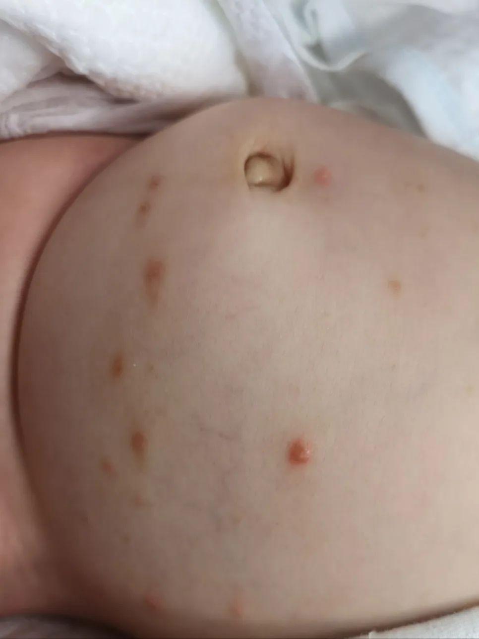 脖子前边痒是生病的前兆,腋窝和脖子痒是什么病的前兆