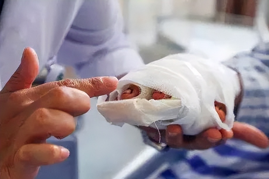 张师傅受伤,张师傅摔伤