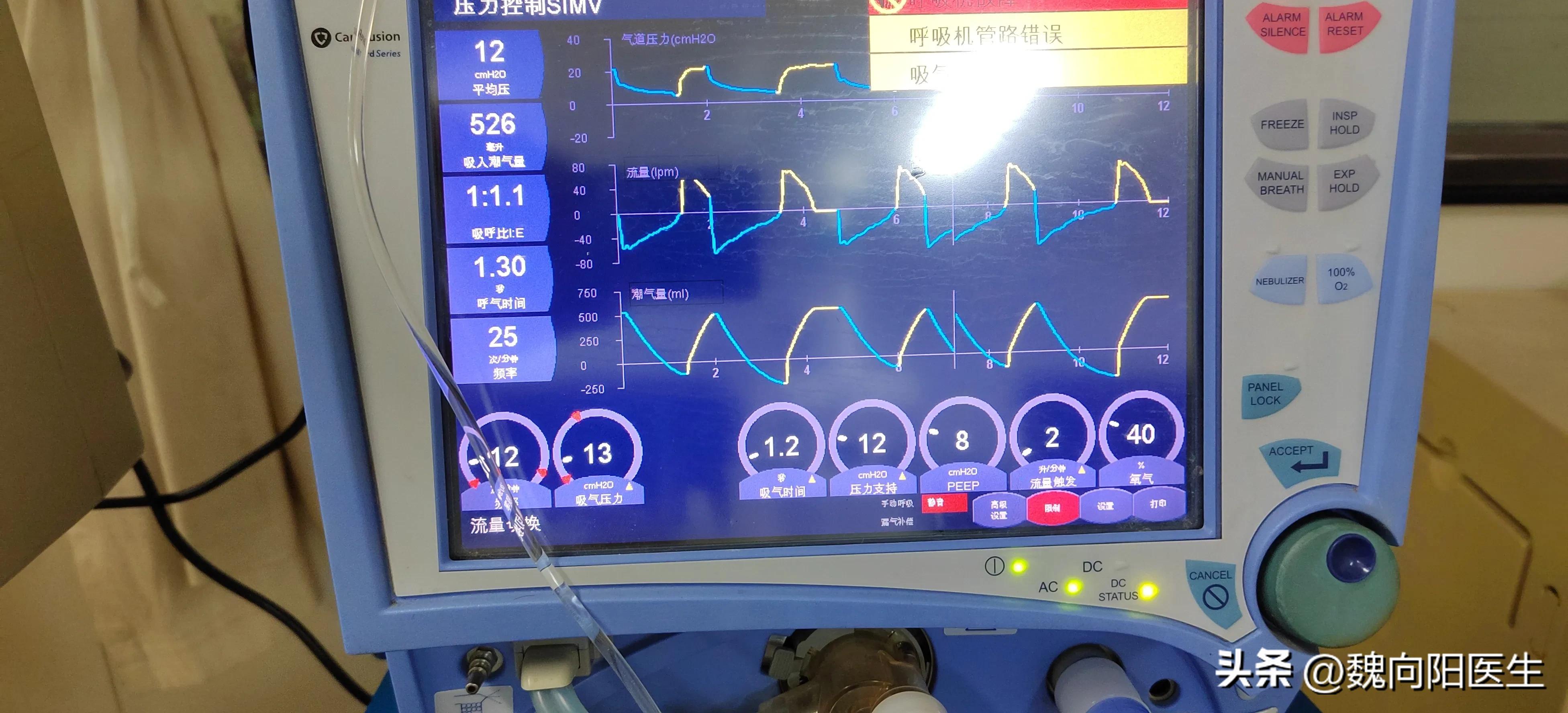 我的父亲大面积脑梗,我父亲脑梗3年后歪着坐在轮椅上