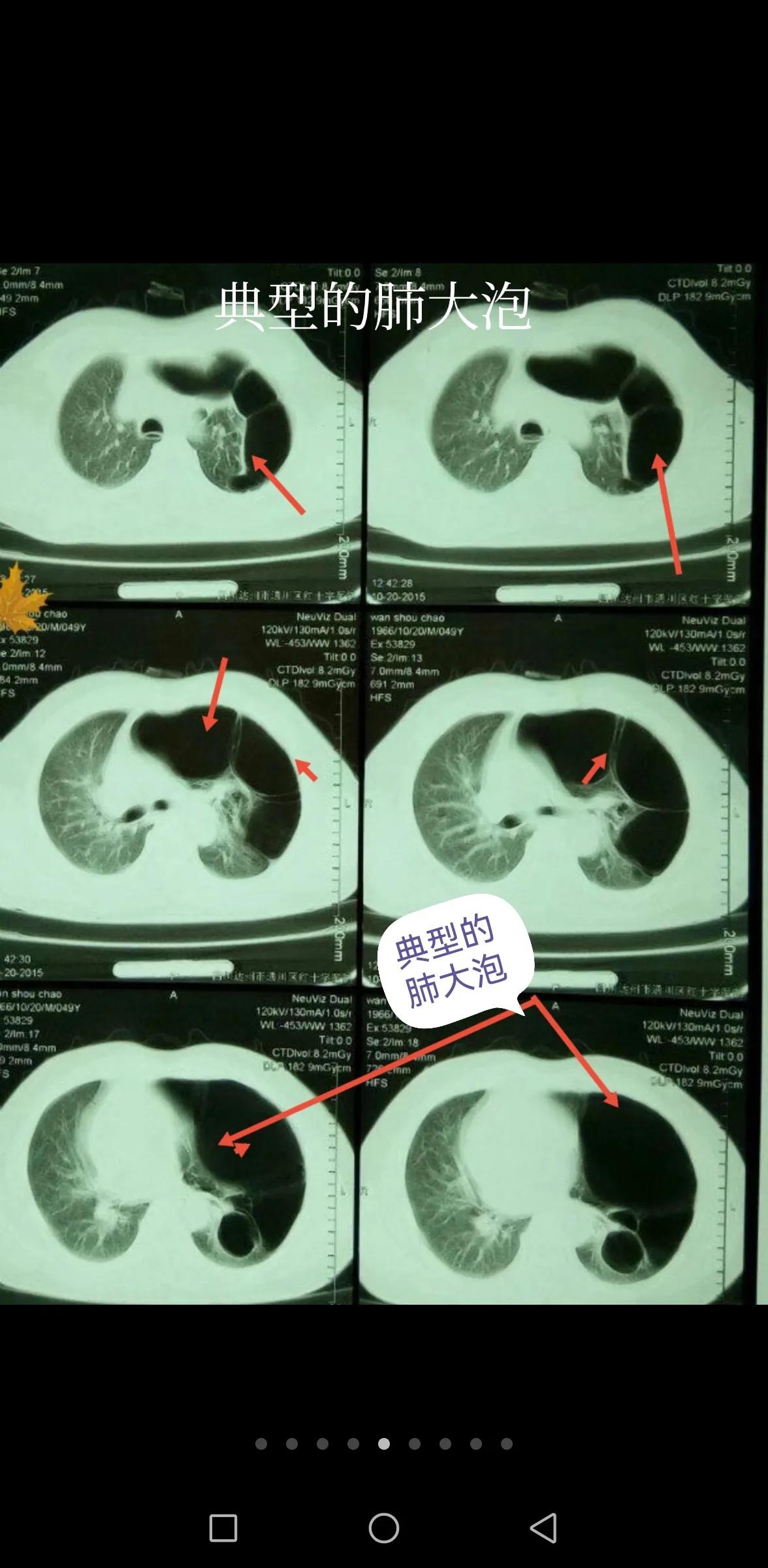 肺大泡产生的原因及治疗方案,肺大泡怎么治疗断根