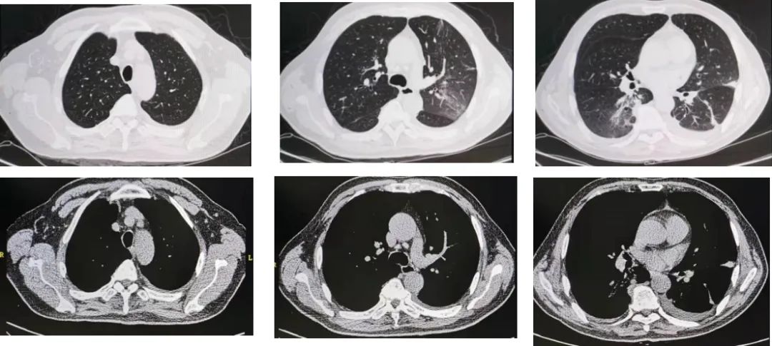 反复发烧但是拍片显示轻微肺炎,一直高烧39-40是肺炎么