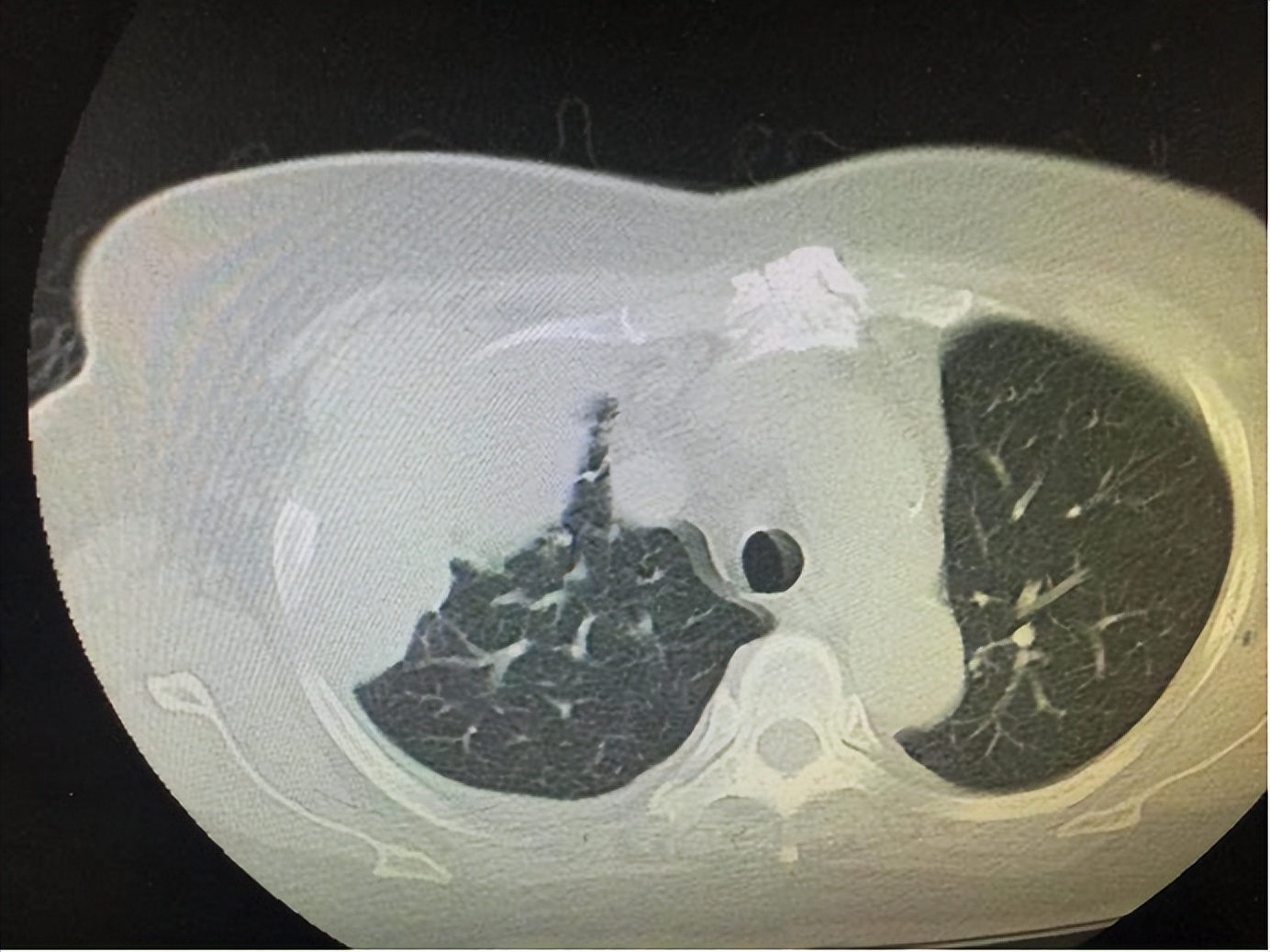 医生教肩膀酸疼缓解的简单动作,肩背痛按摩最好的方法