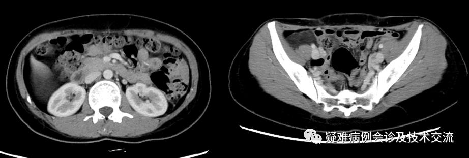 腹膜脂肪肉瘤治愈案例,原发性腹膜后脂肪肉瘤的综合治疗