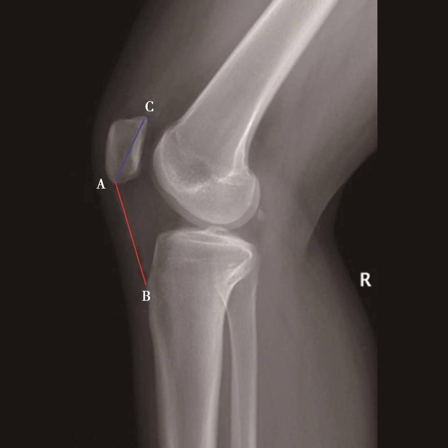 髌骨骨折评估,髌骨上下滑动评估什么内容